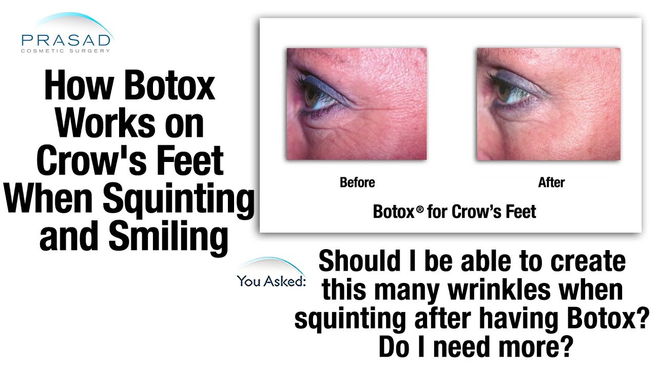 Botox Helps with Muscles that Cause Crow's Feet, but not Soft Tissue Under Eyes