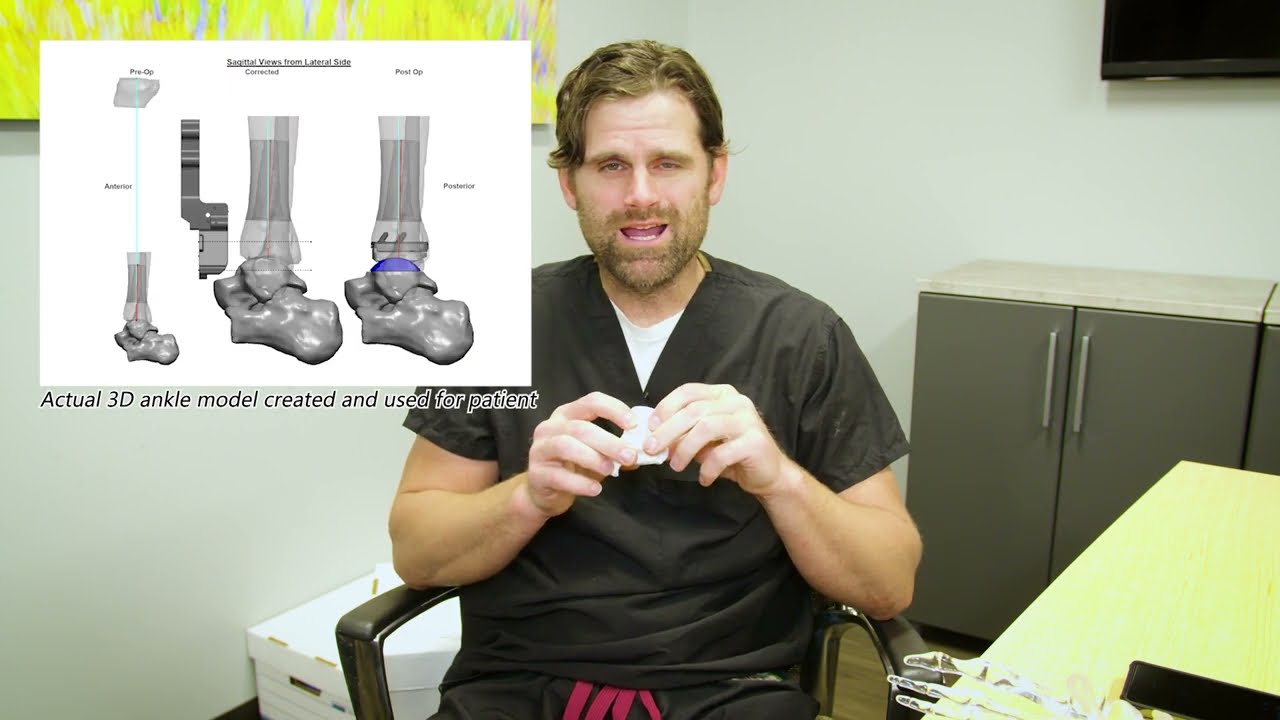 Learn about Total Ankle Replacement with Jason Patterson, M.D. (Part 2 of 2) | OrthoArizona