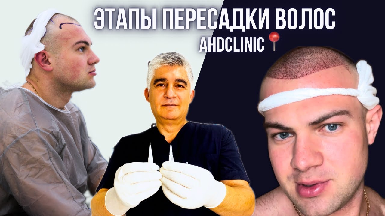 ПЕРЕСАДКА ВОЛОС МЕТОДОМ DHI,В КЛИНИКЕ ДОКТОРА ДОГАНАЙ. ВЛОГ ОТ НИКИТЫ ИГОШЕВА
