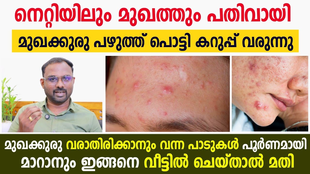 നെറ്റിയിലും മുഖത്തയും കുരുക്കൾ മാറാൻ 4 നാച്ചുറൽ വഴികൾ | How to get rid of fore head & face pimples 💯