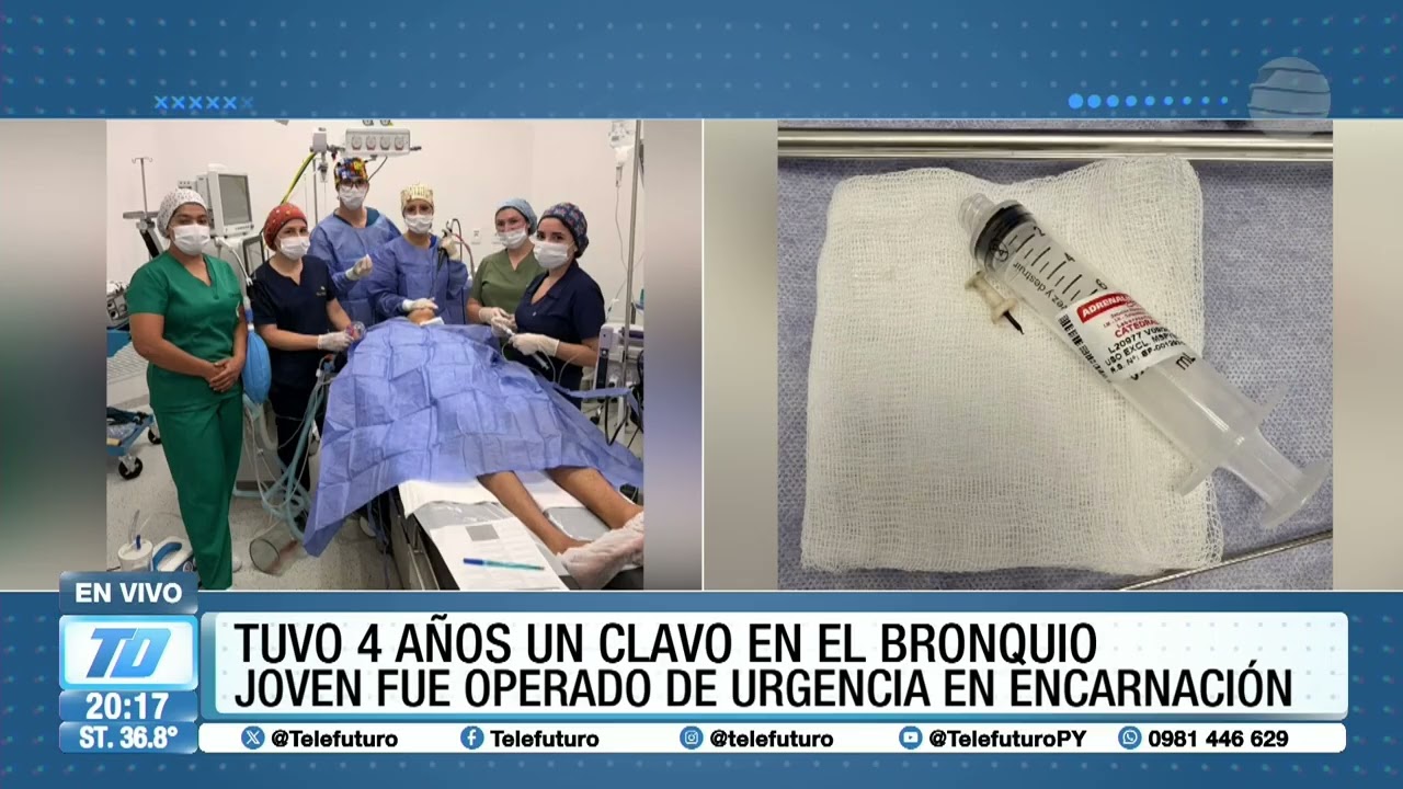 Tuvo 4 años un clavo en el bronquio, joven fue operado de urgencia en Encarnación