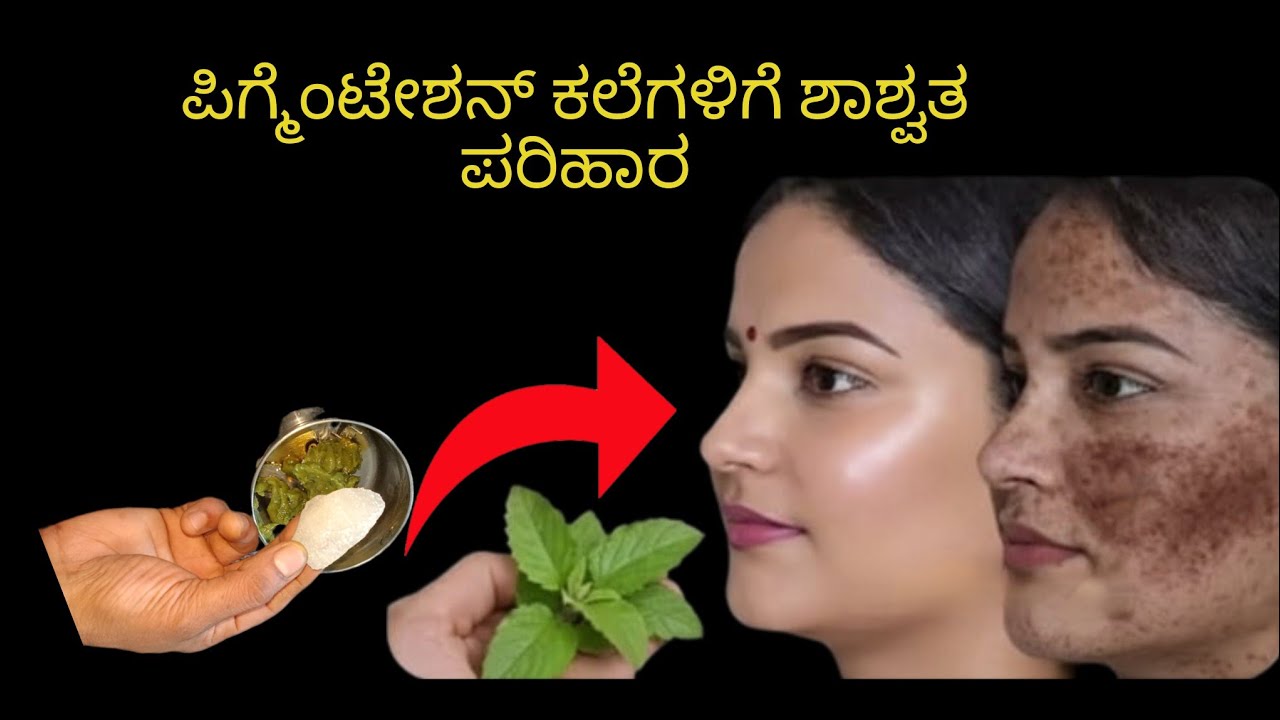 ಪಿಗ್ಮೆಂಟೇಶನ್ ಬಂಗು ಕಪ್ಪು ಕಲೆಯನ್ನು ಶಾಶ್ವತವಾಗಿ ಮನೆಯಲ್ಲಿ ಹೋಗಲಾಡಿಸಲು ಇಲ್ಲಿದೆ ಪರಿಹಾರ