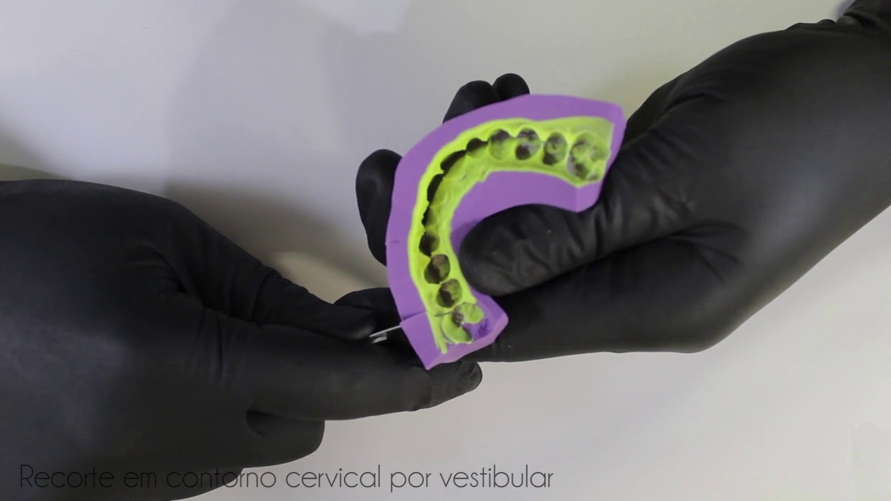 Mock-Up com resina bisacrílica – da confecção do guia de silicone à instalação em boca