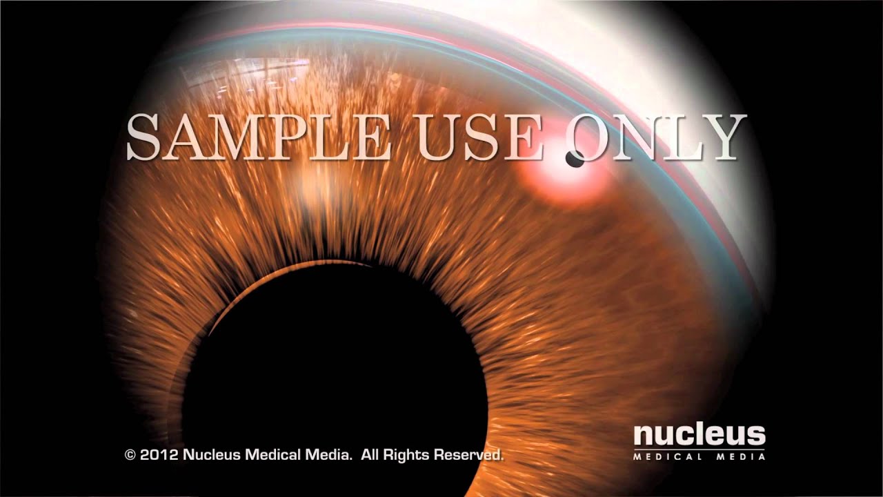 Cirugía de glaucoma