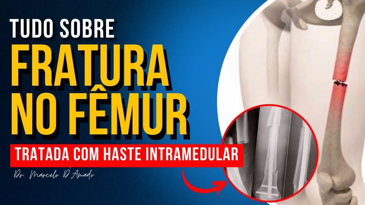 O QUE É E O TIPO DE HASTE INTRAMEDULAR USADA NA FRATURA DIAFISÁRIA DO FÊMUR!