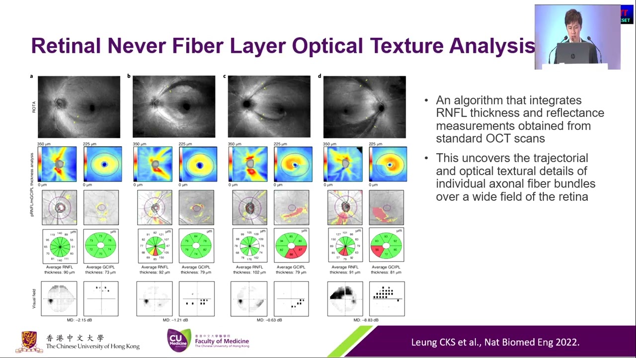 AIOS2025 GP28 T Dr Poemen CHAN The Ocular Hypertension Treatment Study OHTS &ndash; an Update and the Futu