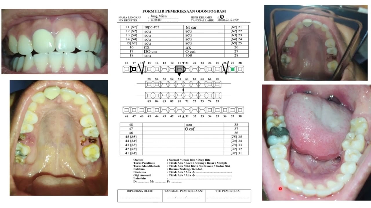 Pengisian Odontogram Kemenkes dan interpol