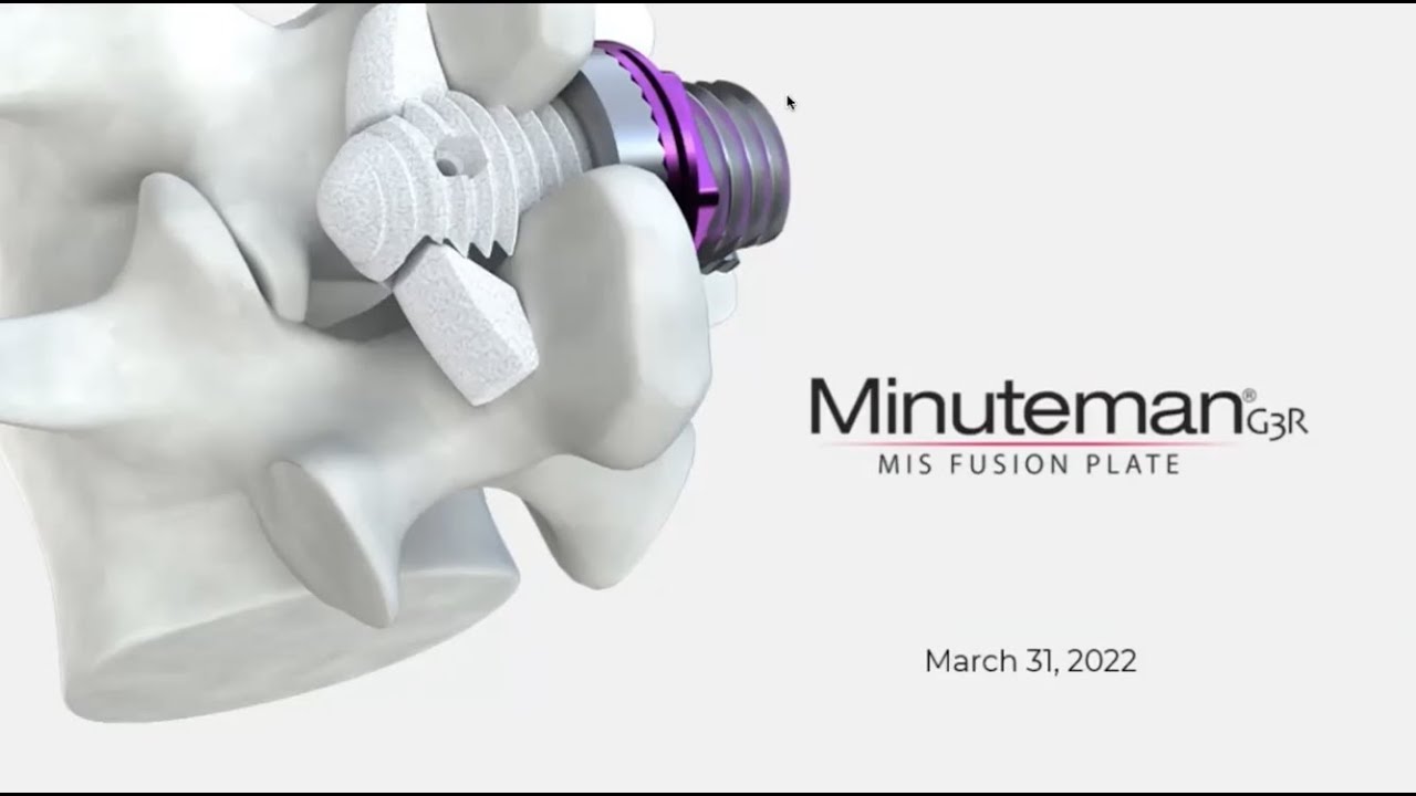Minuteman Fusion Treatment | Webinar | Pain and Spine Specialists
