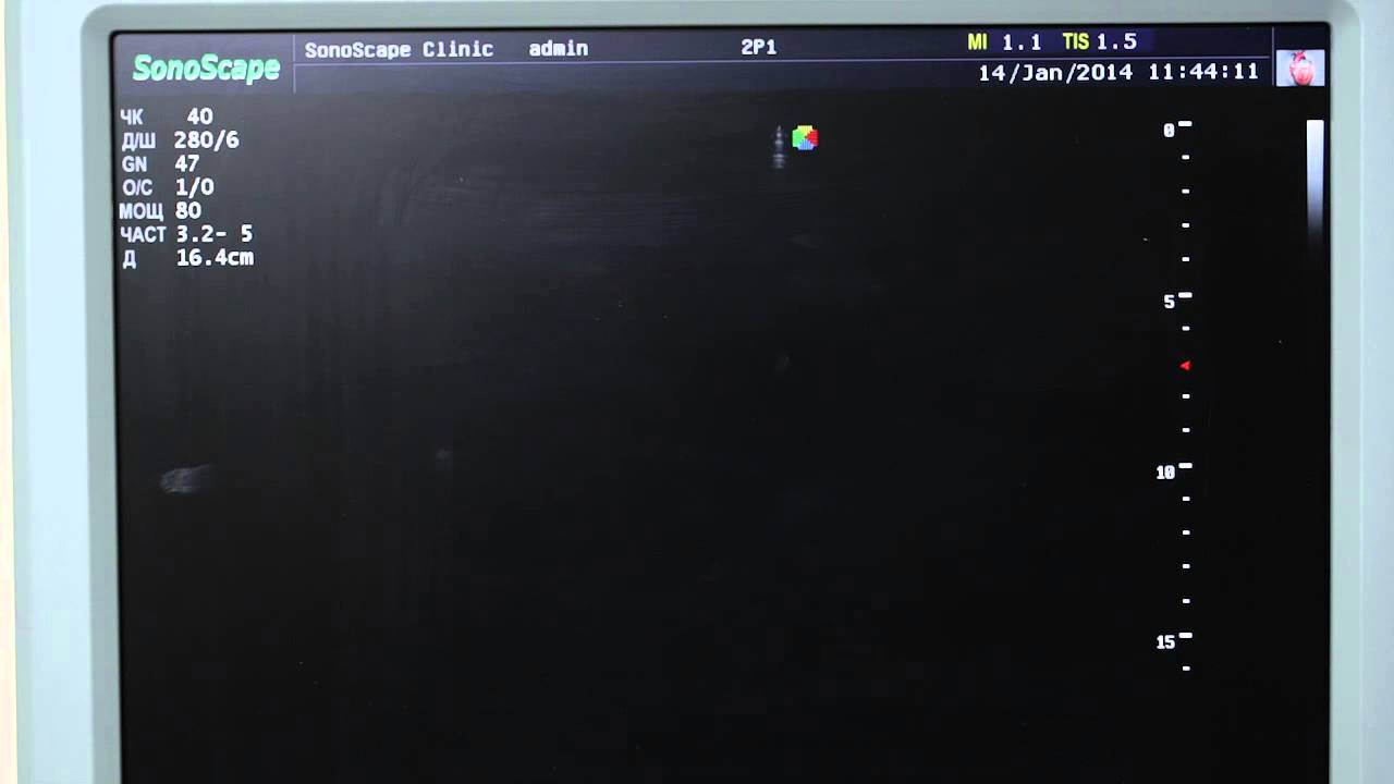 Sonoscape s6 pro - 06 Кардиологочиские режимы 720