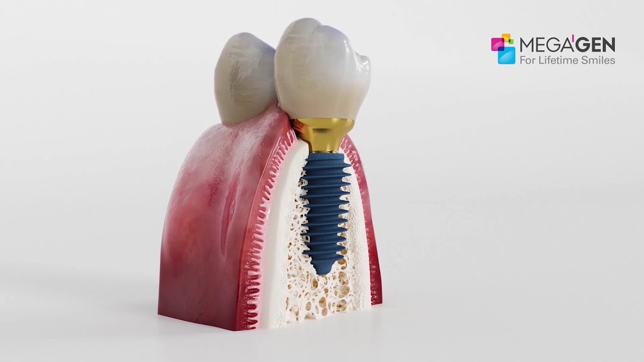 Megagen AnyrRidge | Dental Implant