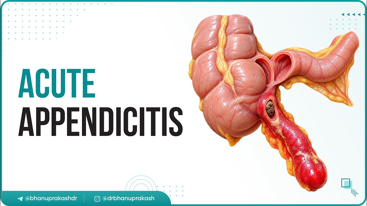 Acute appendicitis USMLE Step 1 : Etiology, Pathophysiology, Clinical Features, Diagnosis, Treatment