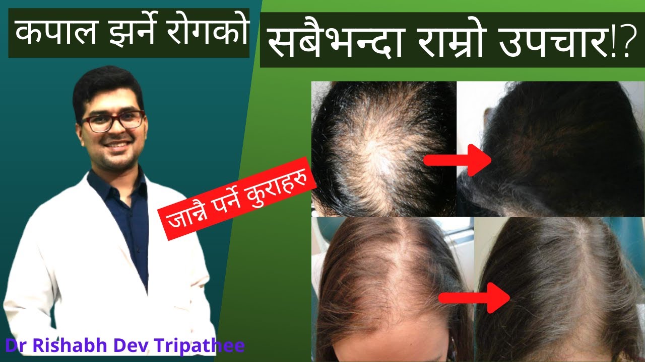 कपाल किन झर्छ?यसको रोकथाम कसरी गर्ने ? Kapal Jharne Kaaran ra Upachar [ Telogen Effluvium/Hair Fall]