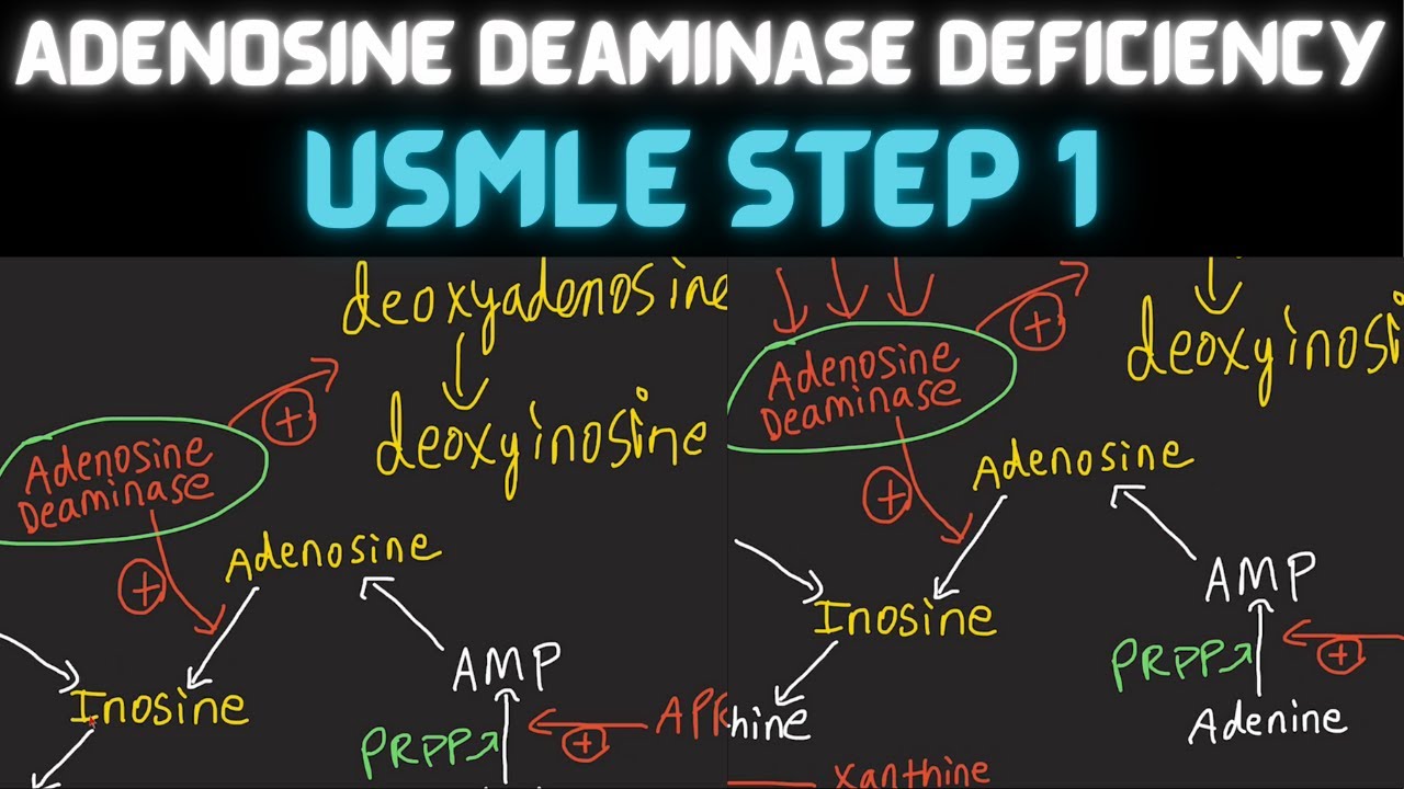 Adenosine Deaminase Deficiency | Biochemistry | Pathology | USMLE Step 1