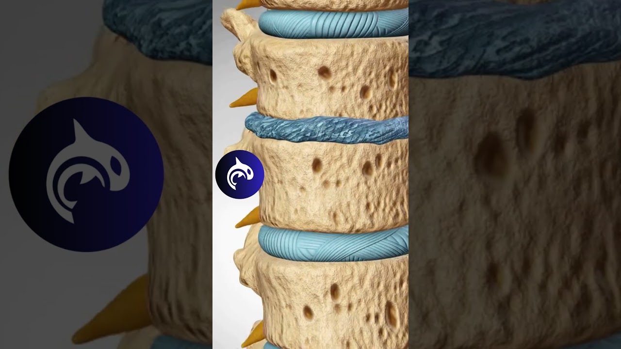 Degenerative Disc Disease - 4K 3D Animation