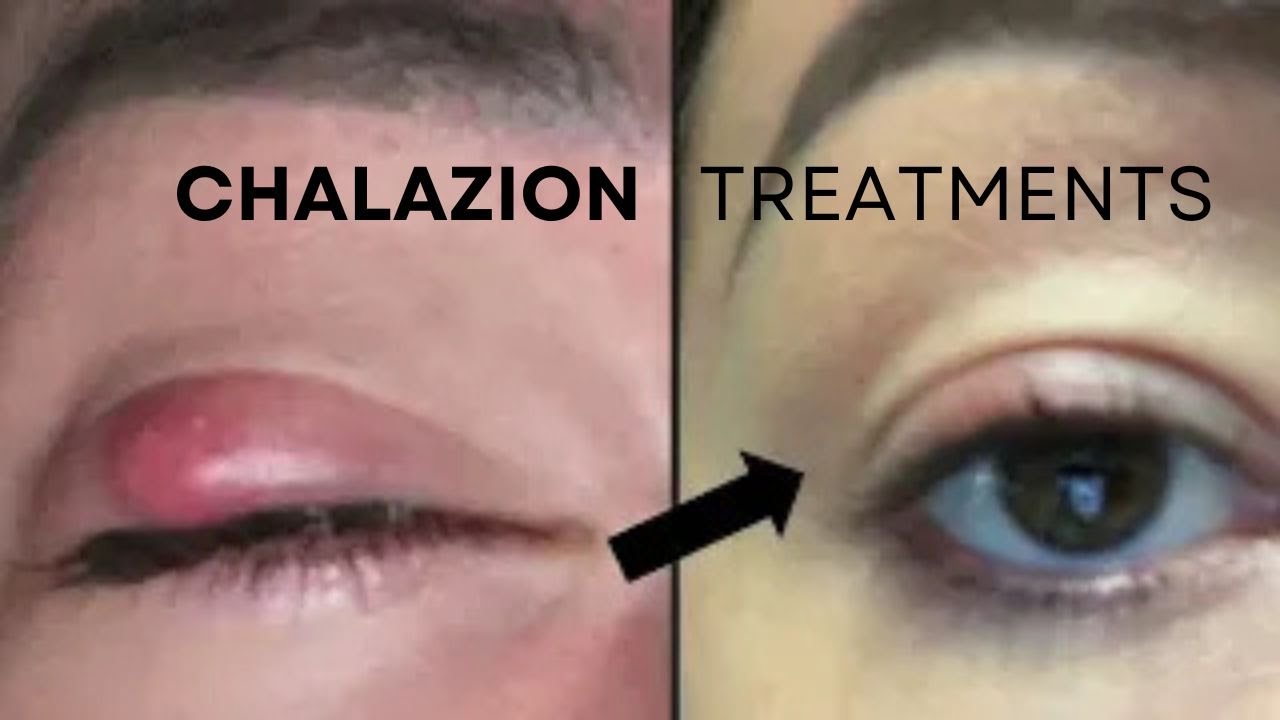 Chalazion treatments without Cutting or Blades: NICE Technique @GulaniVision