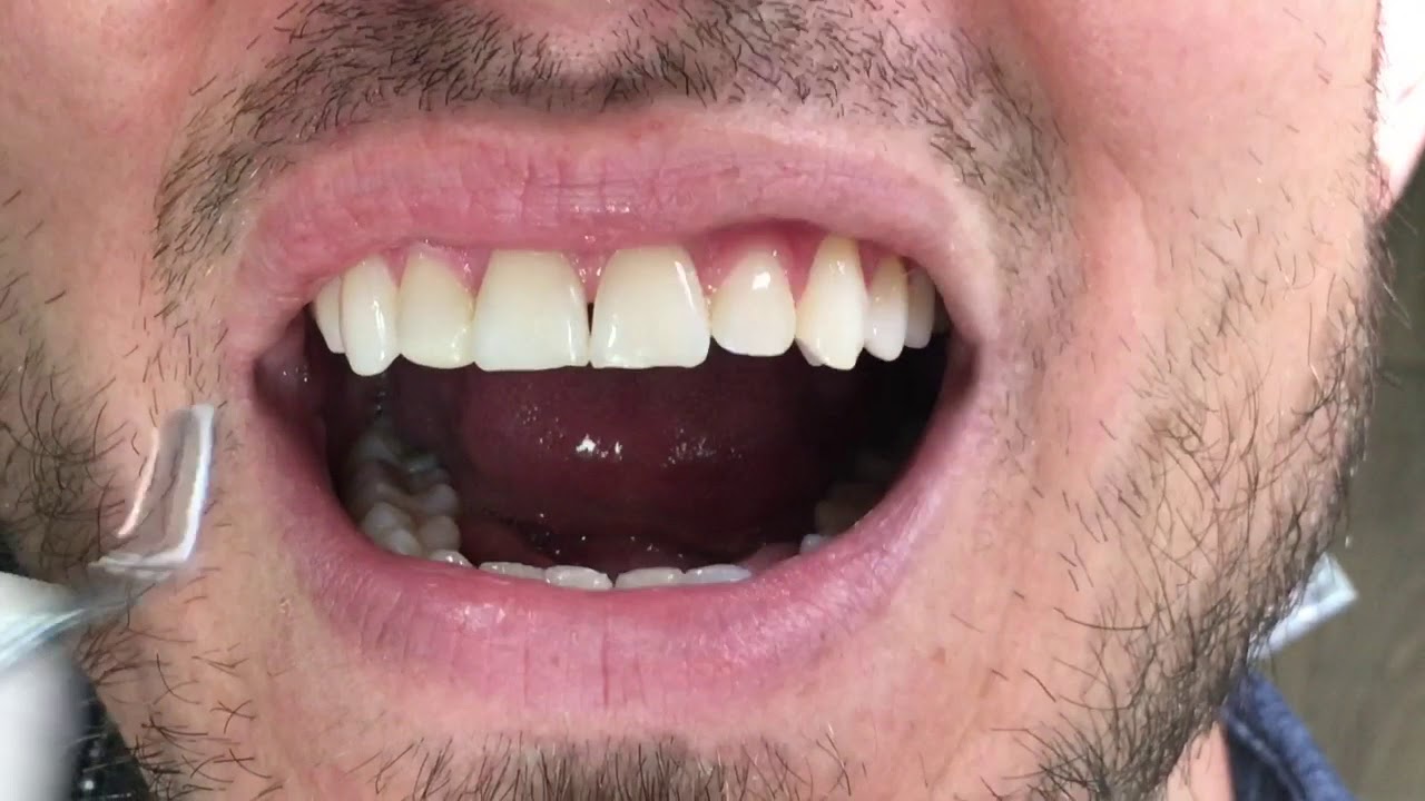 Houston Cosmetic Dentist....5 minutes that can change your smile !