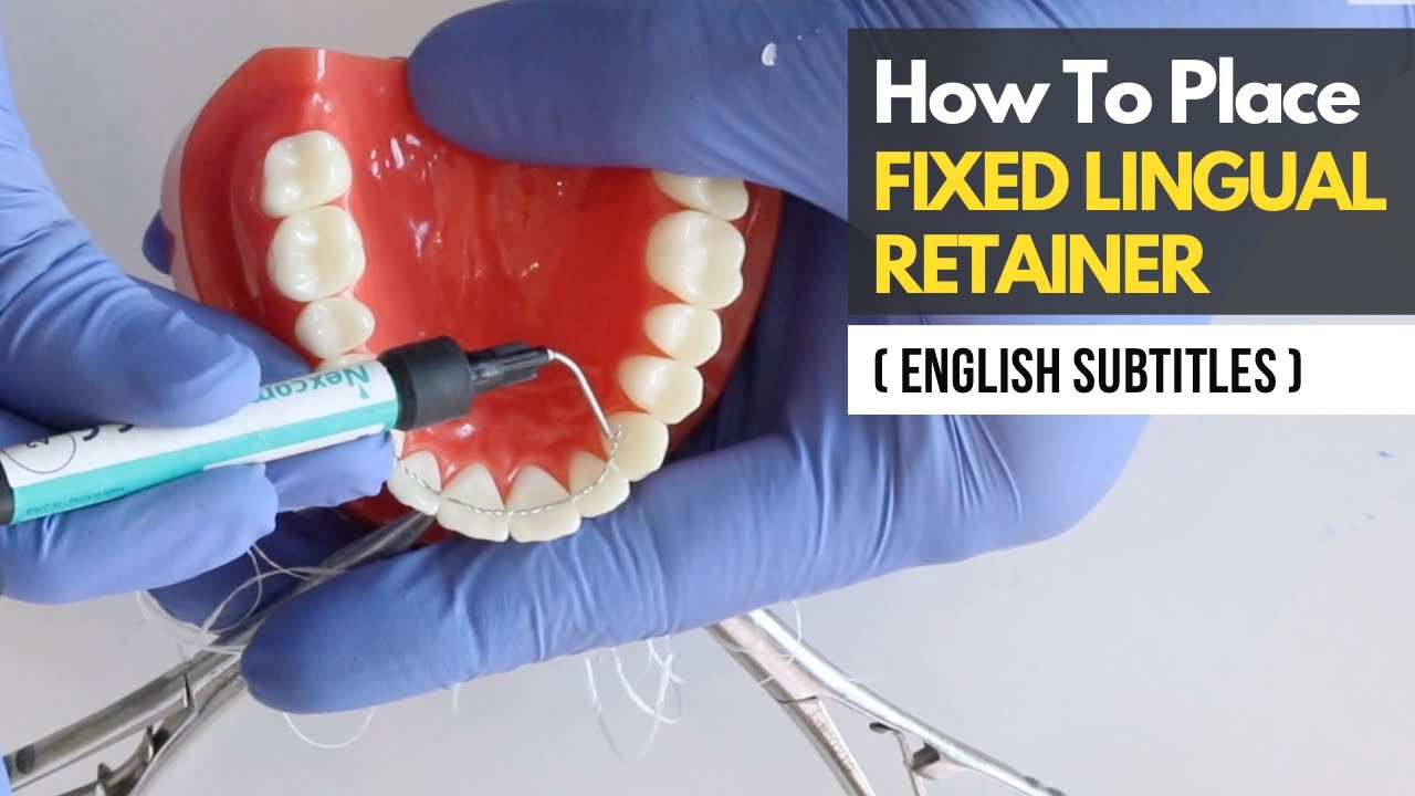 How to Place Fixed Lingual Retainer in 4 minutes!