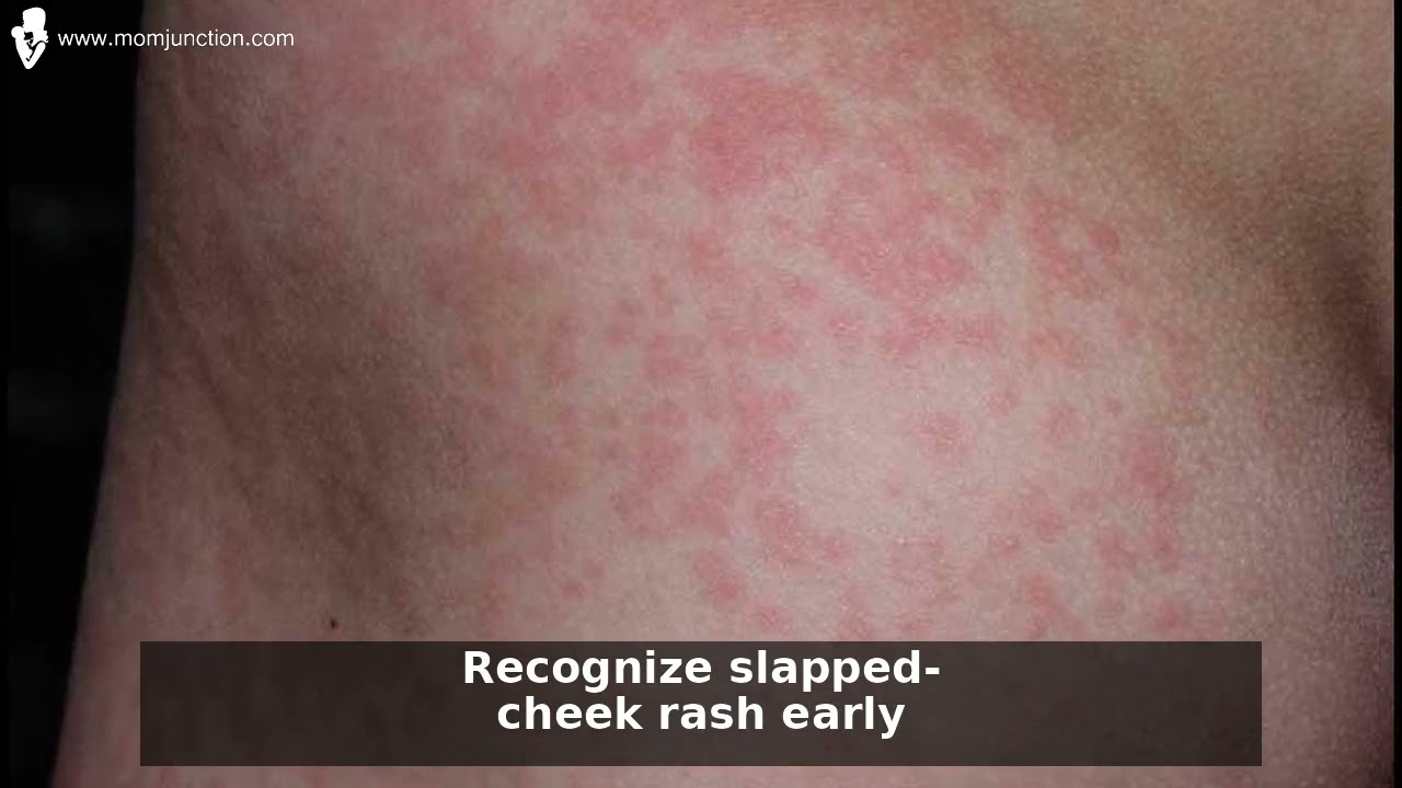Fifth Disease (Slapped Cheek): Symptoms & Prevention Tips