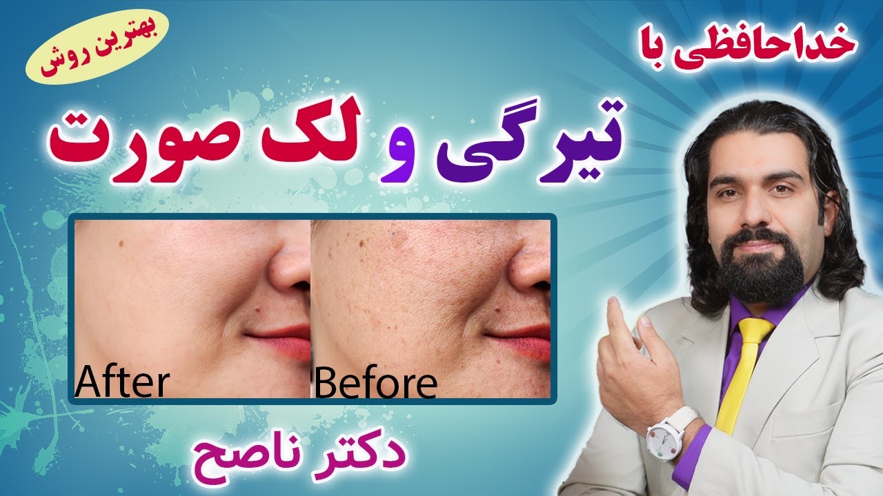 بهترین روش رفع لک و تیرگی صورت / دکتر ناصح/ بهترین ماسک، کرم و تغذیه برای رفع تیرگی و لک قهوه ای