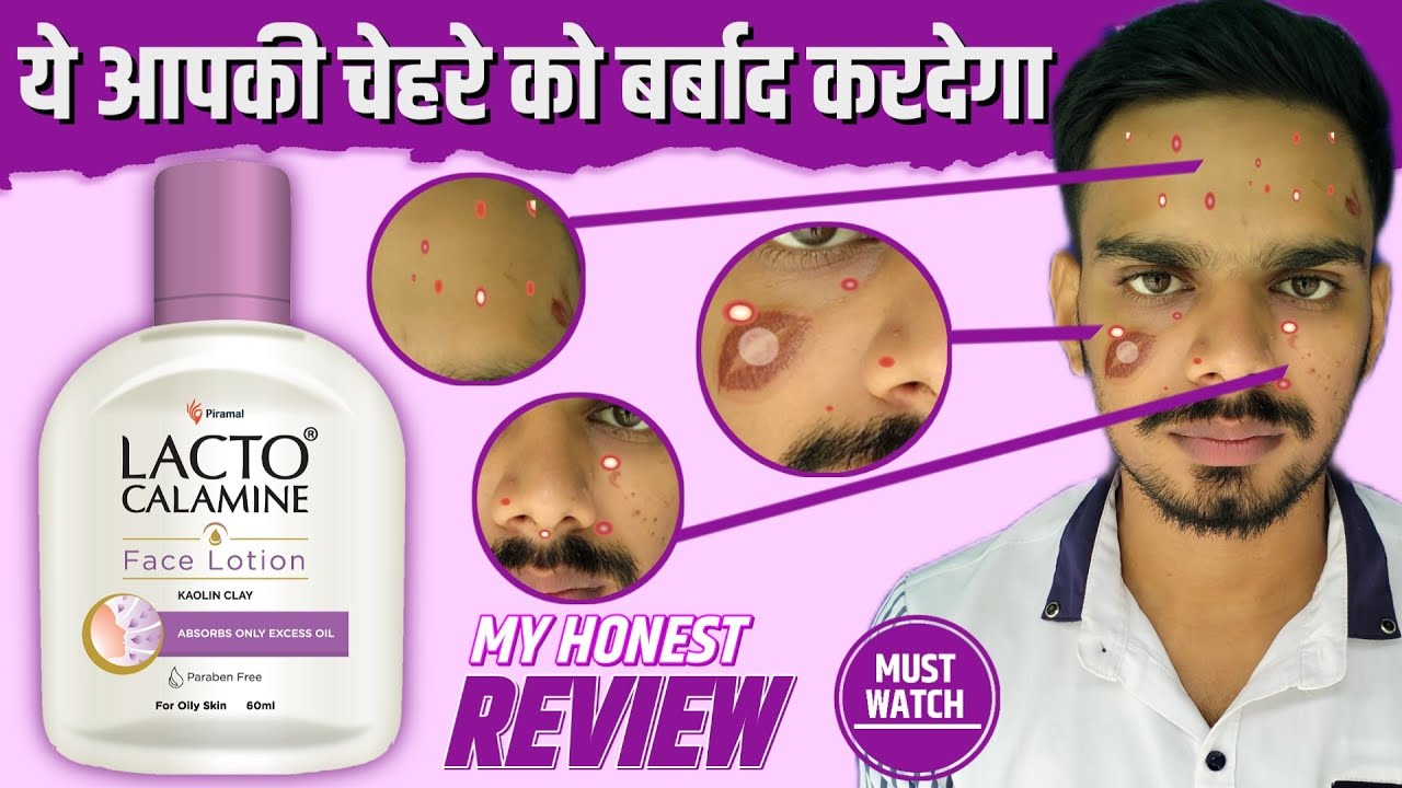 You Must Watch This Video Before Using Lacto Calamine Face Lotion