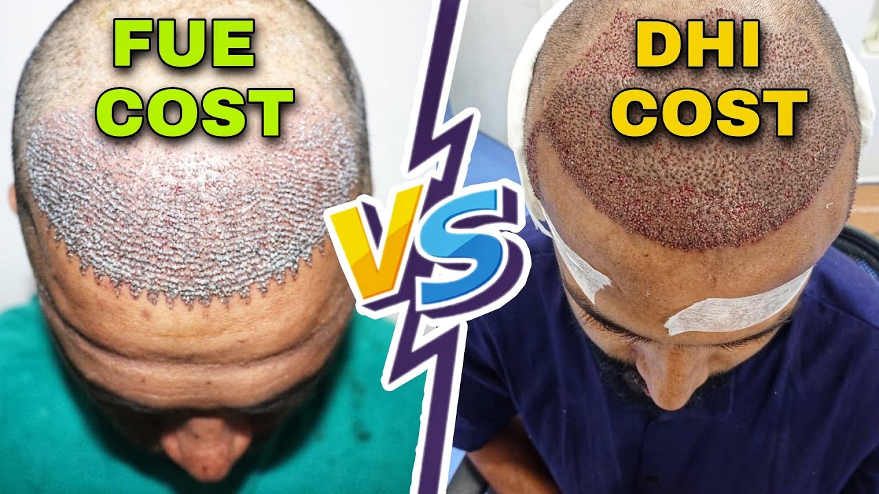 DHI Cost Vs. FUE Cost Explained !!! || Latest Hair Transplant Cost In India 2020