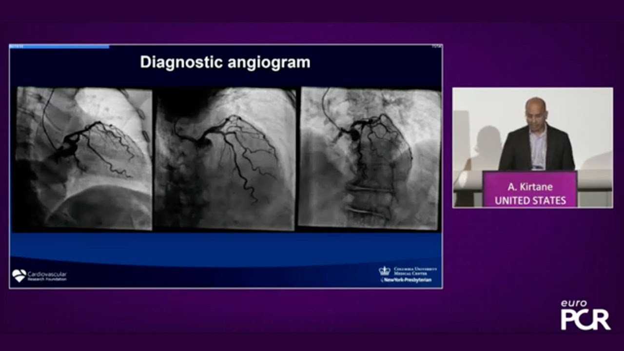 Integrating FFRangio into your daily practice - Empowering wire-free insights - EuroPCR 2023