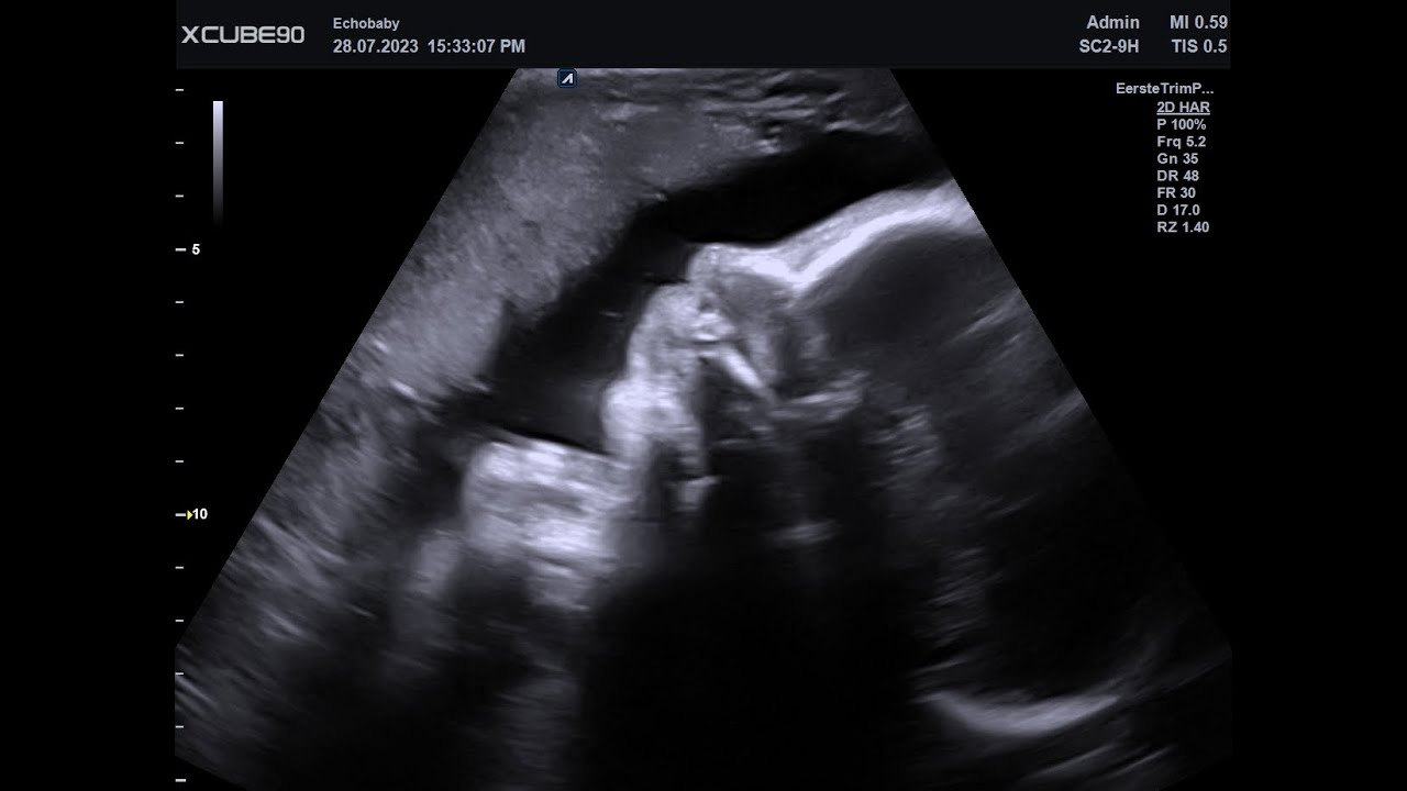 Baby Echo 31 Weken Zwanger Foto's