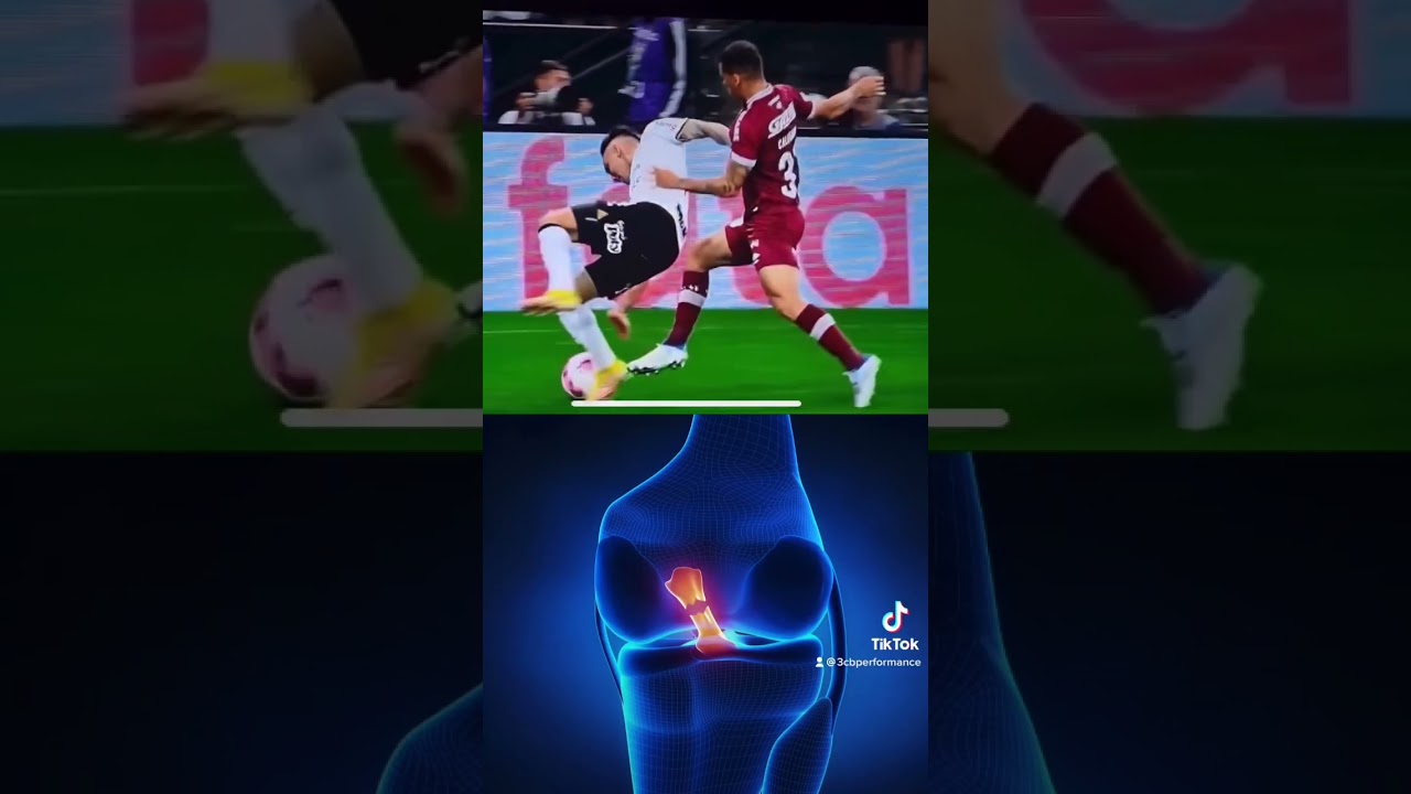 Prototypowe zerwanie więzadła krzyżowego przedniego. #acl #b&oacute;lkolana #piłka nożna #futbol #kolano #spodenkipiłkarskie #regeneracjawięzadła krzyżowego przedniego