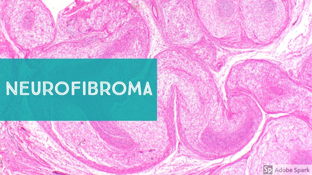 Neurofibroma, Neurofibromatosis-1, and Low Grade MPNST