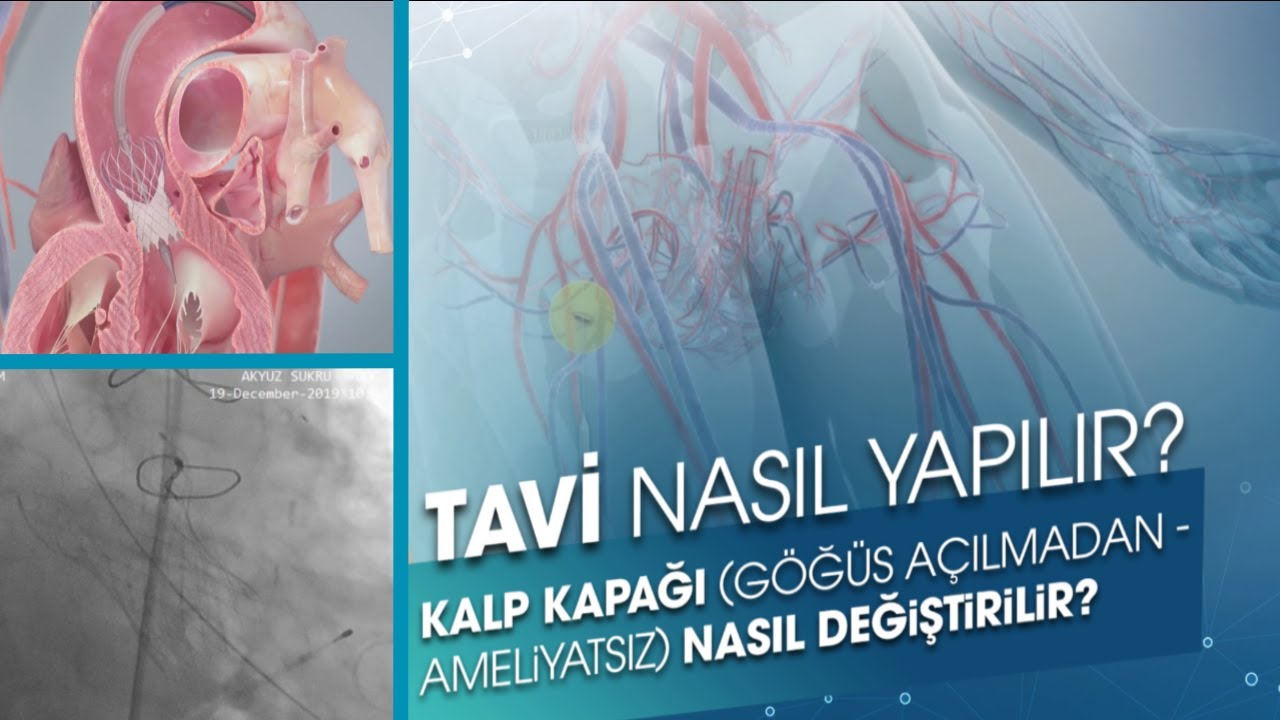 TAVI NASIL YAPILIR? | Kalp Kapağı Ameliyatsız Nasıl Değiştirilir?
