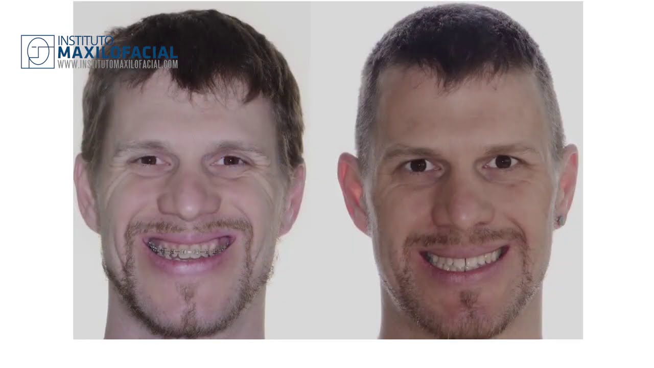 Orthognathic bimaxillary surgery. Case # 68: David- Class III bite, maxillary hipoplasia