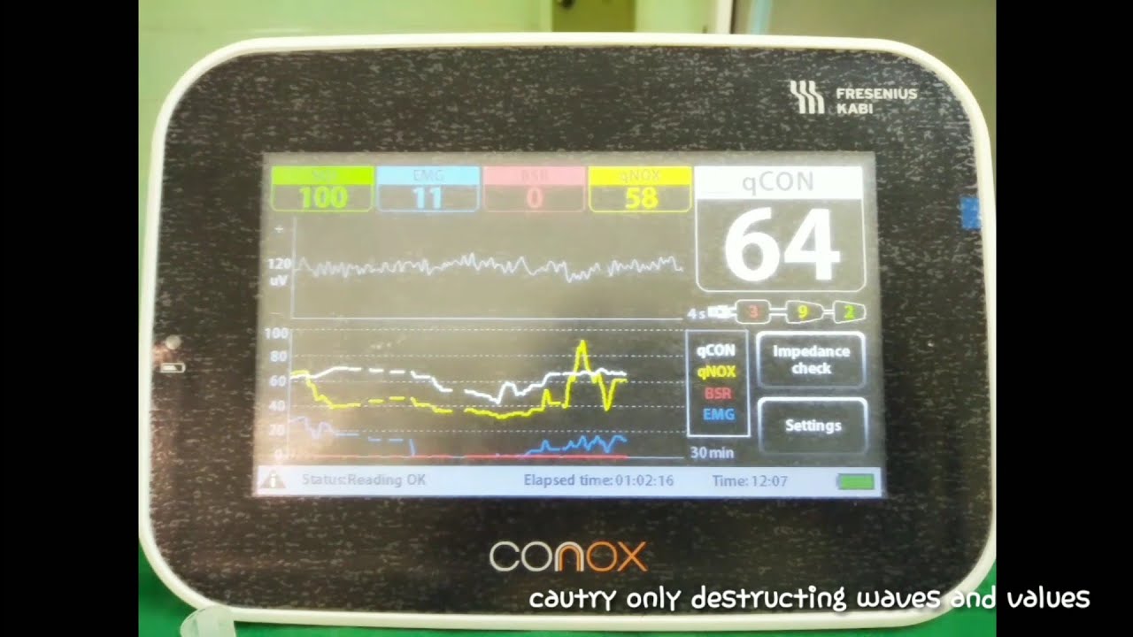 How to use and monitor CONOX SENSOR FOR GENERAL ANAESTHESIA