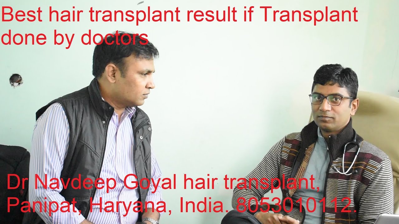 Result of FUE Hair transplant, Dr Navdeep Goyal, Panipat. 9416500112
