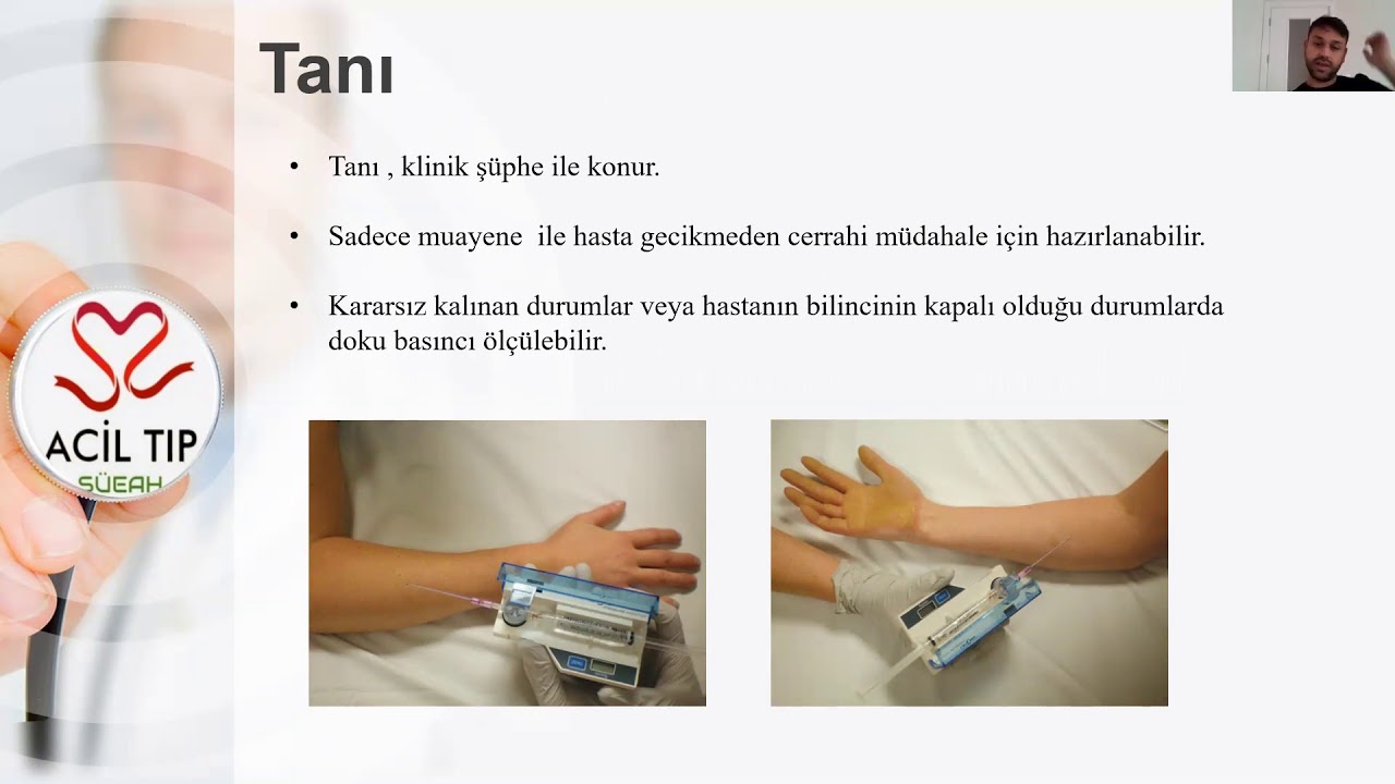Kompartman Sendromu