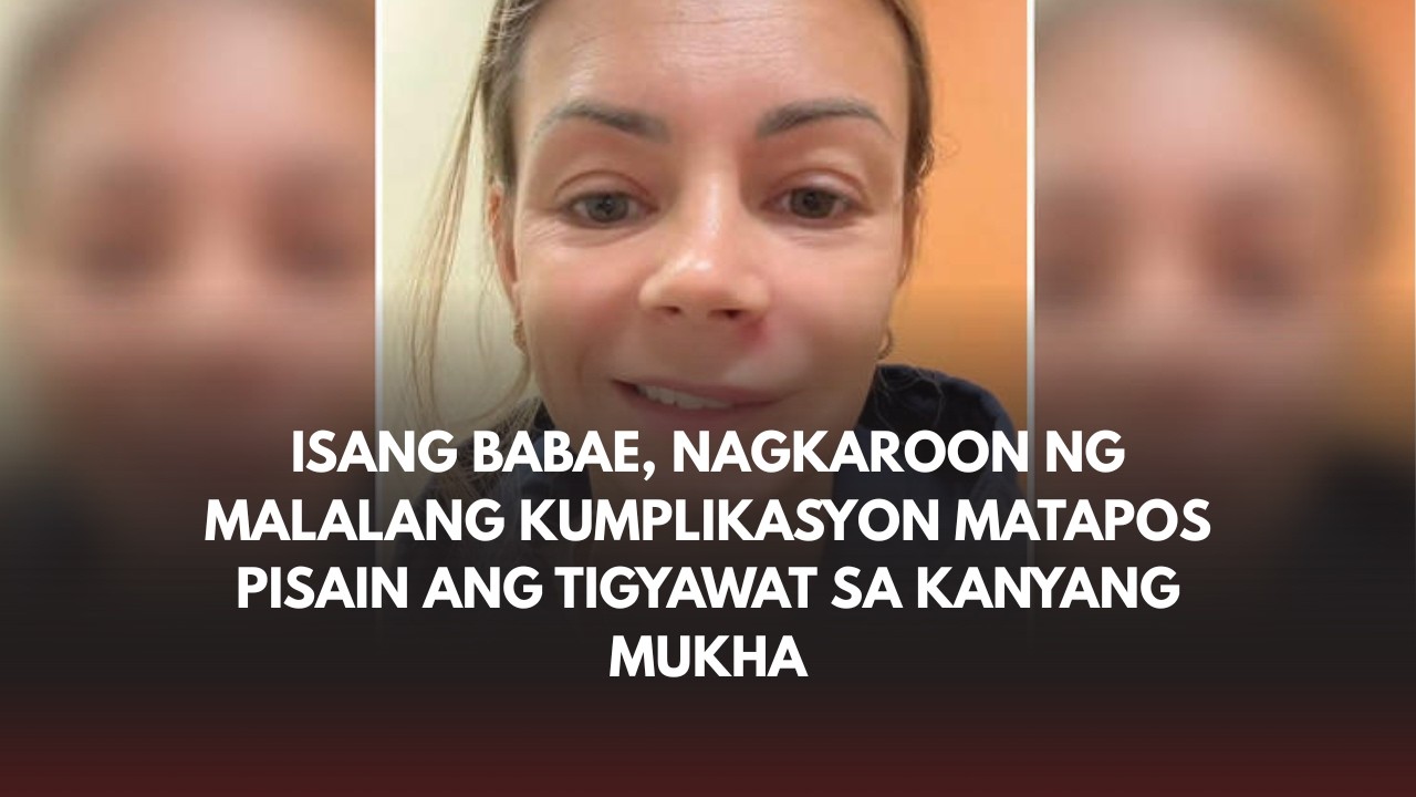 Isang babae, nagkaroon ng malalang kumplikasyon matapos pisain ang tigyawat sa kanyang mukha