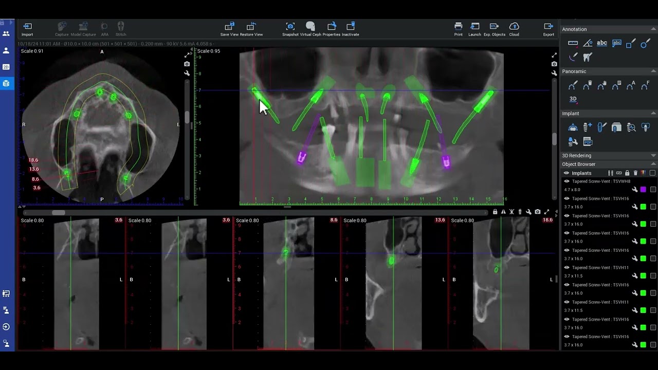 Pterygoid Dental Implant Planning in Romexis