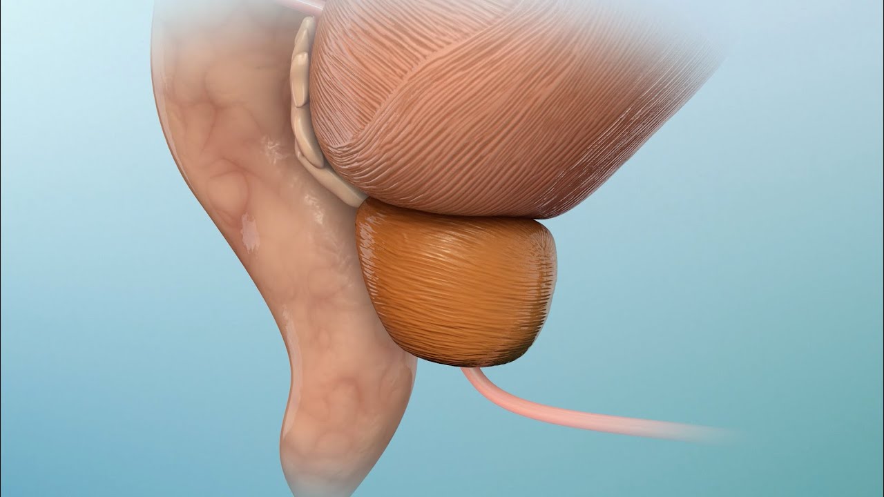 Comprender el c&aacute;ncer de pr&oacute;stata