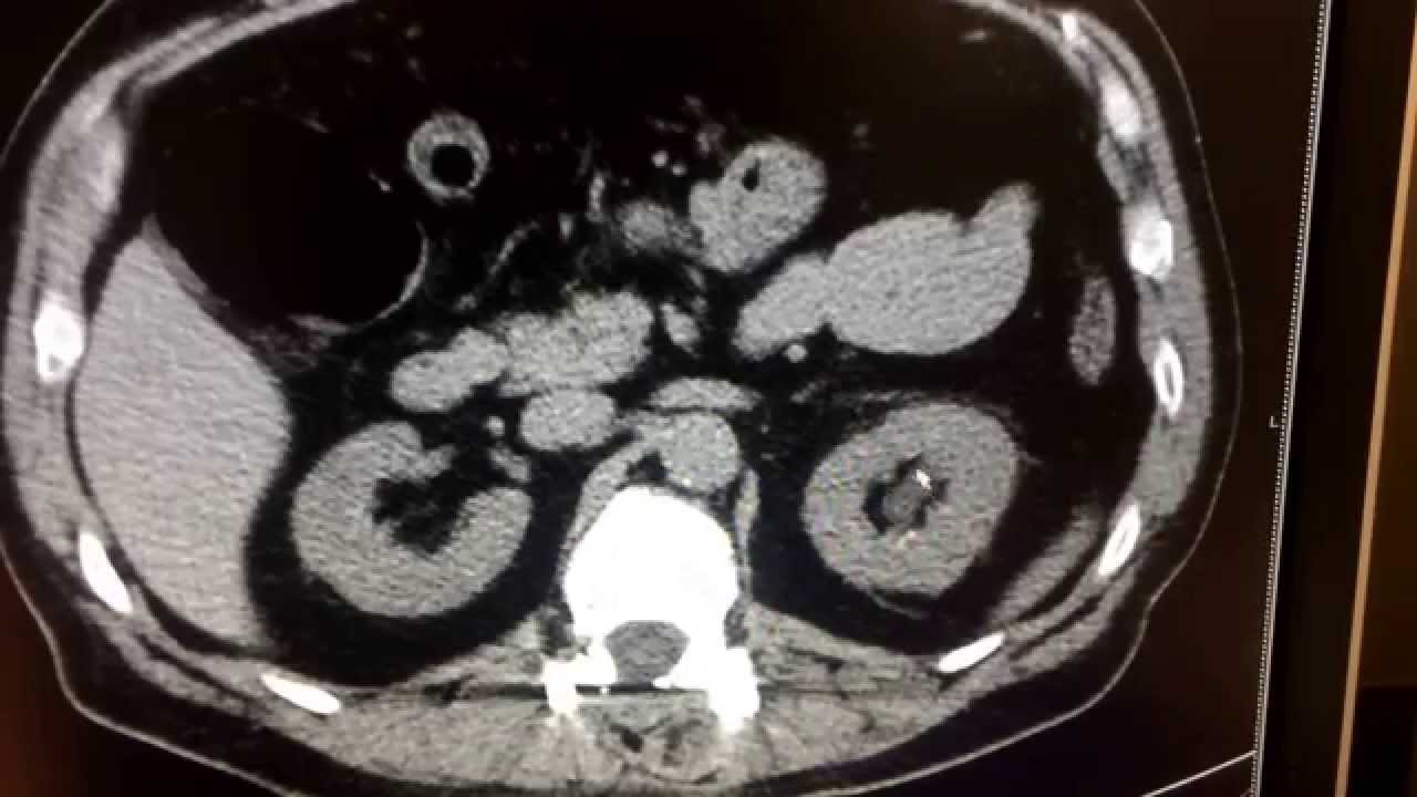 CT scan for kidney stone