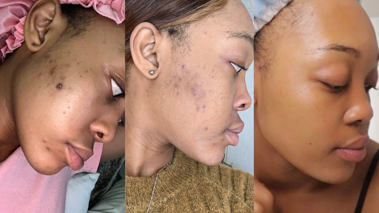 The Skin Care Routine that cleared my acne & hyperpigmentation | OG Parley