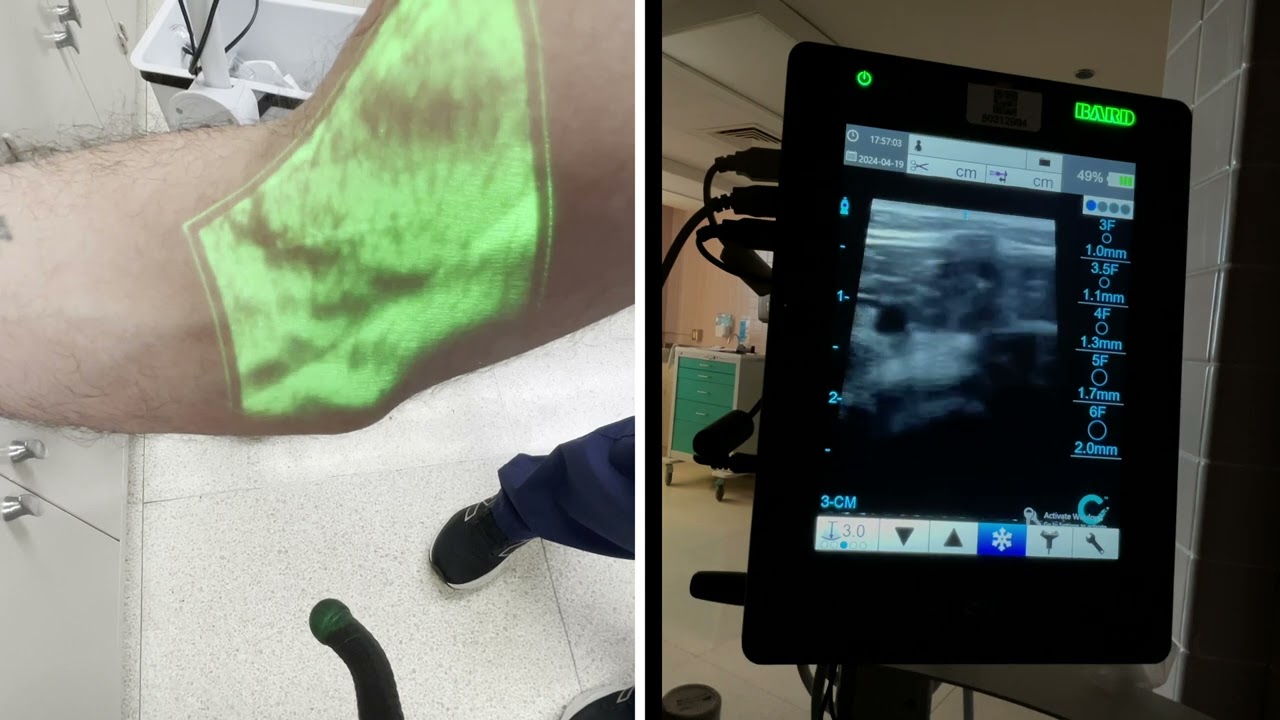 Vein Finder VS Ultrasound