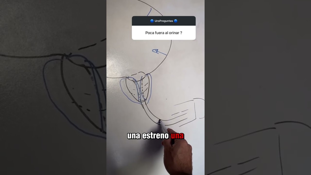 Poca Fuerza al Orinar: &iquest;Vejiga o Obstrucci&oacute;n?