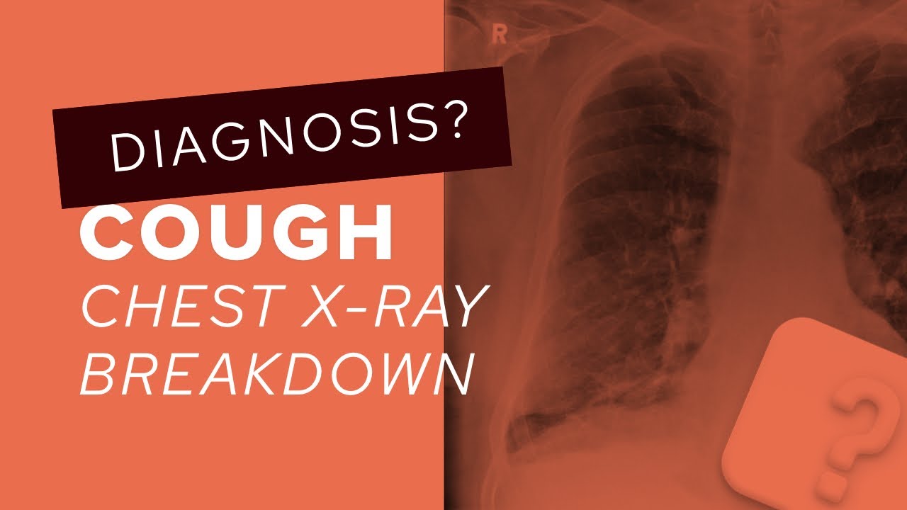 Chest X-Ray breakdown: assessing a film with pleural plaques