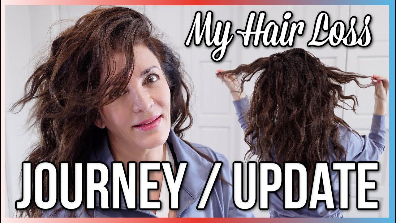 My Hair Loss Journey / Update | Hair Regrowth Treatments | StyleByZaza