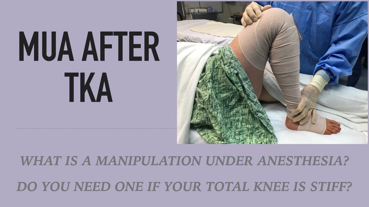 MUA Knee Treatment: What Patients Need to Know