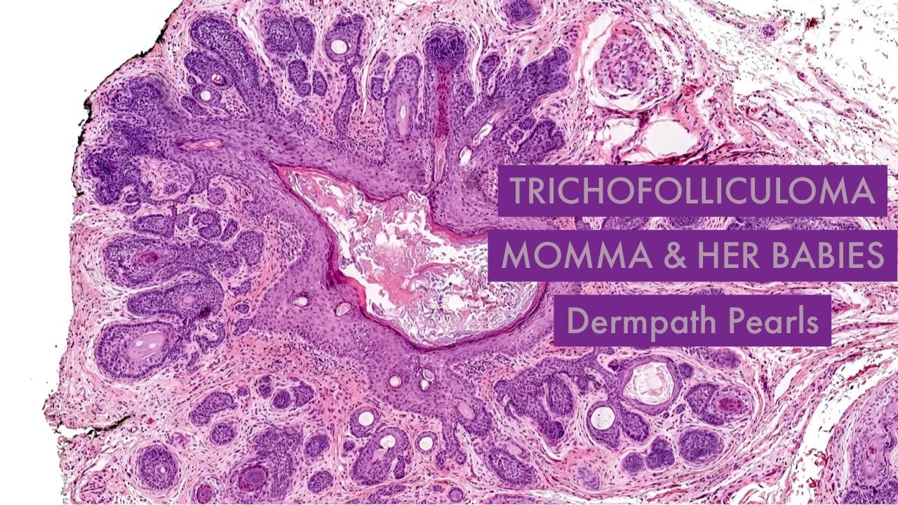 Trichofolliculoma - momma and her babies Unk 15 #leeunknowns #dempathmadeEZ