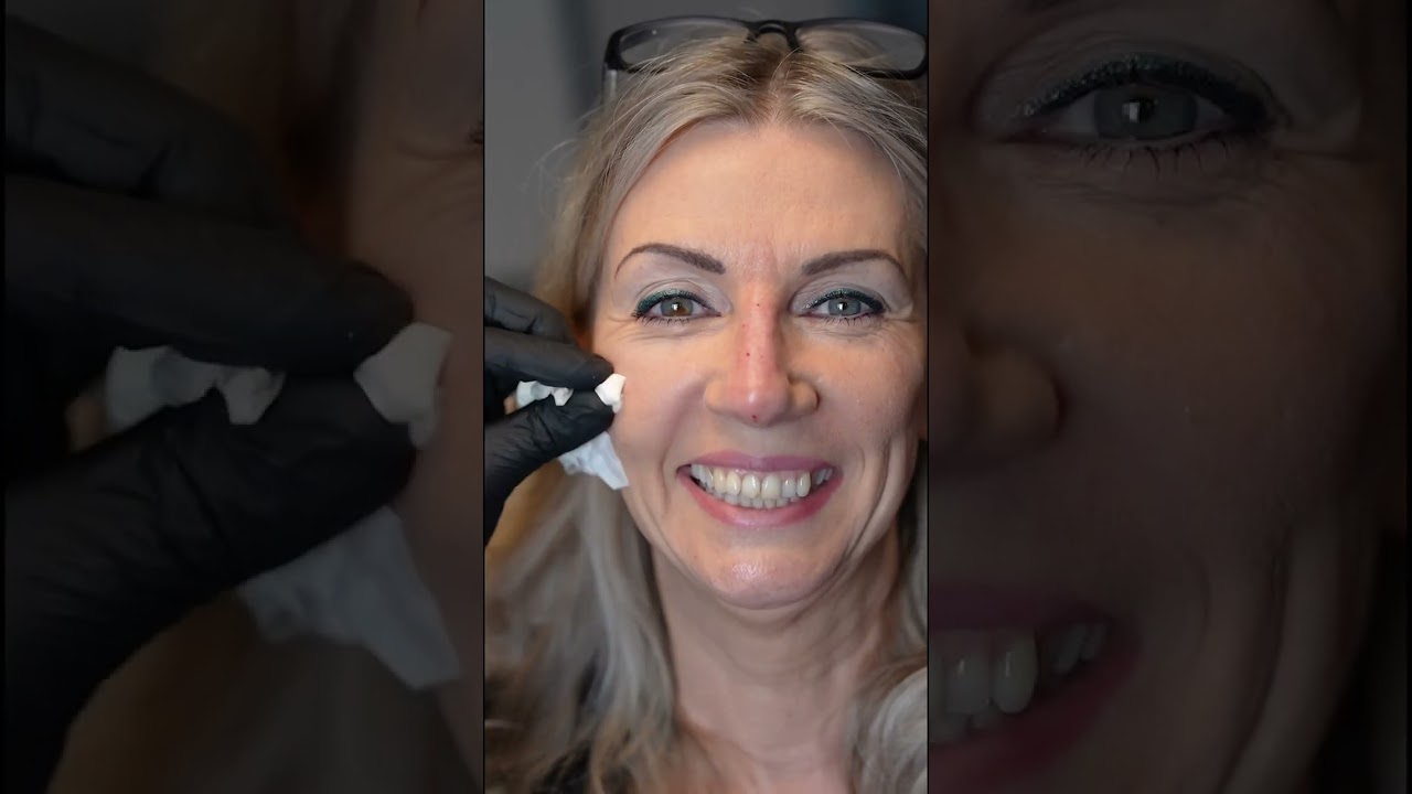 Liquid Facelift - Fullface Behandlung bei DR. NICK
