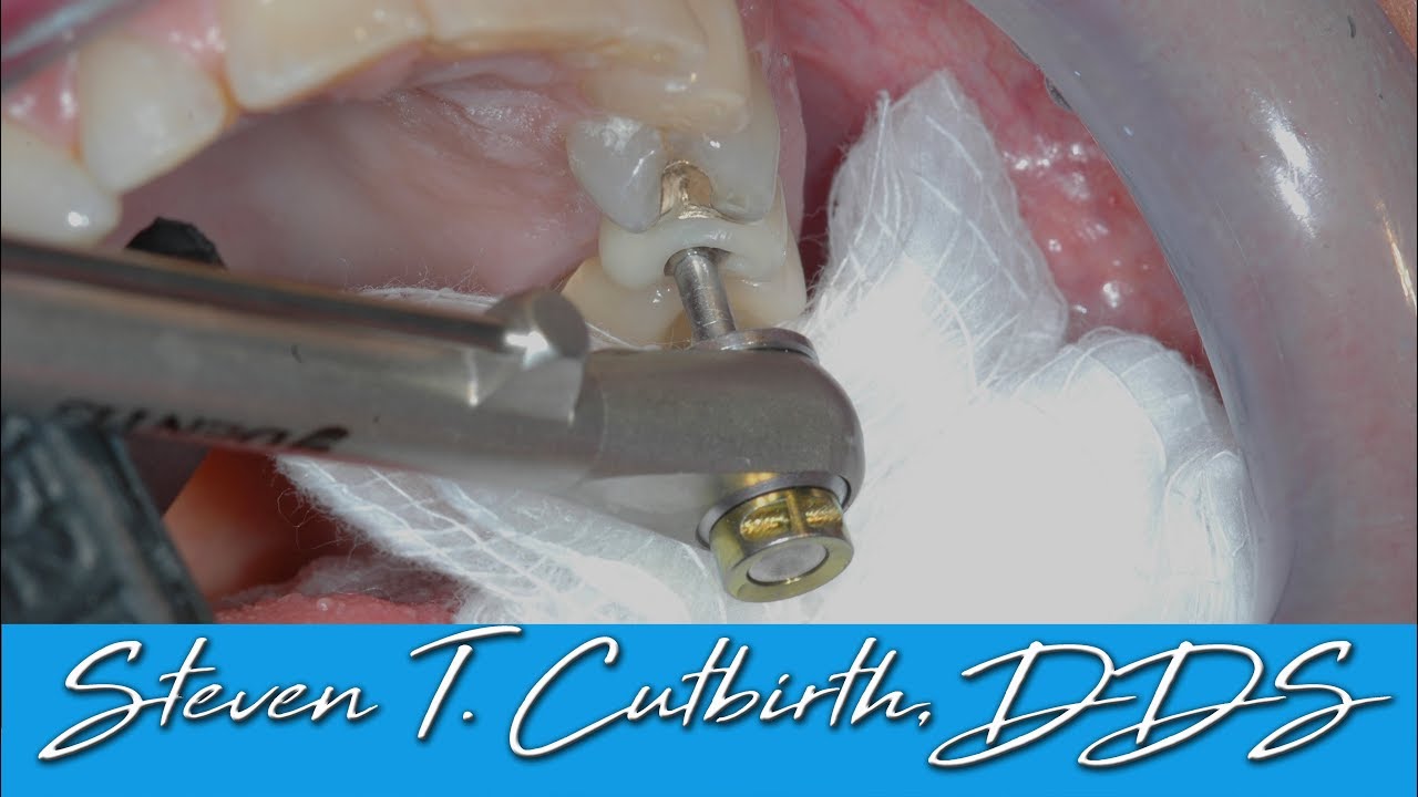 Loose Implant Screw - Dental Minute with Steven T. Cutbirth, DDS