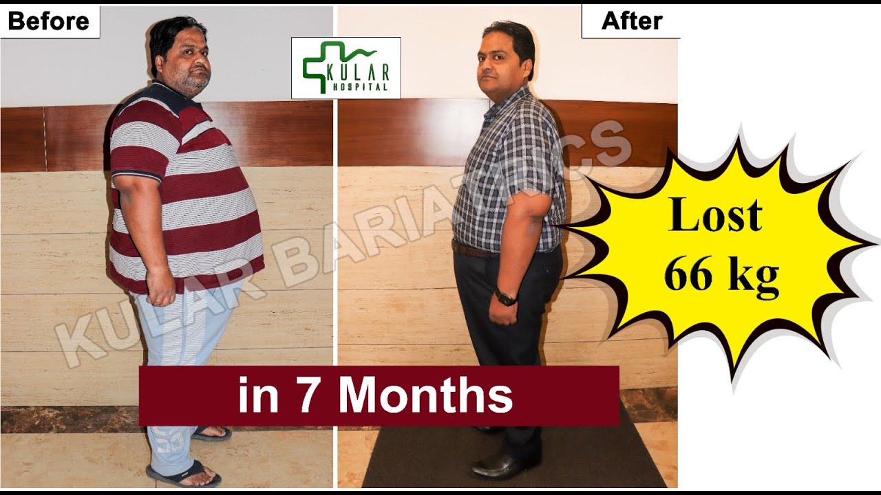 MGB in obesity, World class center of excellence in Punjab, India @ Kular Hospital