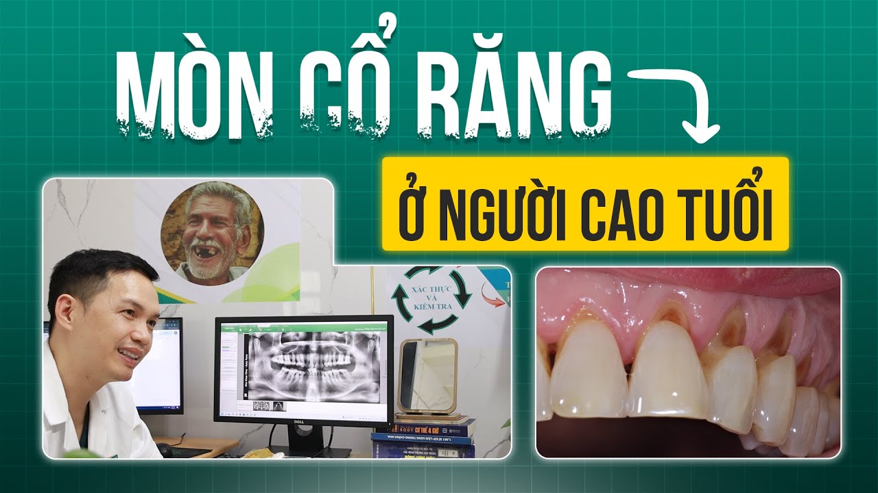 Cách Xử Lý Mòn Cổ Răng Ở Người Cao Tuổi | Nha Khoa Hina