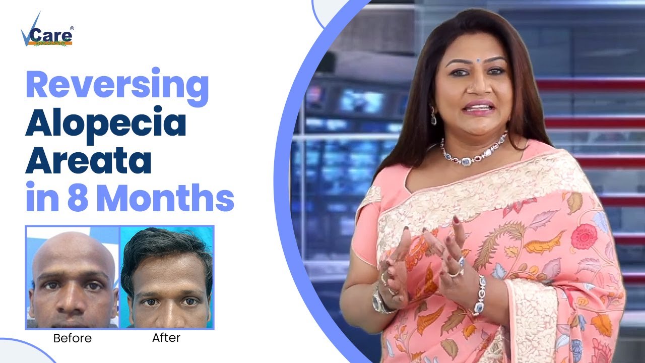 Alopecia Areata Treatment | Hair Transformation by VCare | Success Stories by VCare